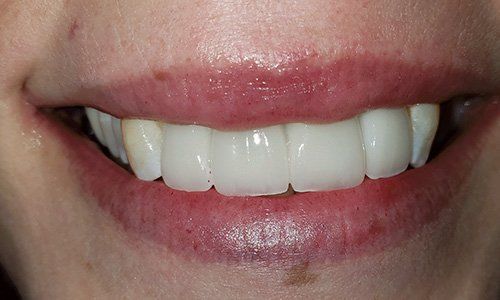 dental implants - Dentist Lancaster CA