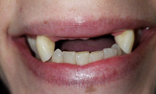 dental implants - Dentist Lancaster CA