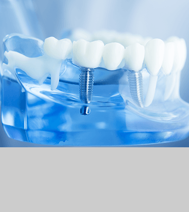 Dental Implants -  Dentist CA 93536